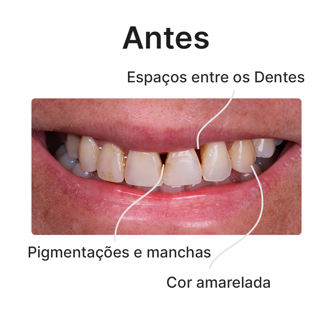 Antes-V5