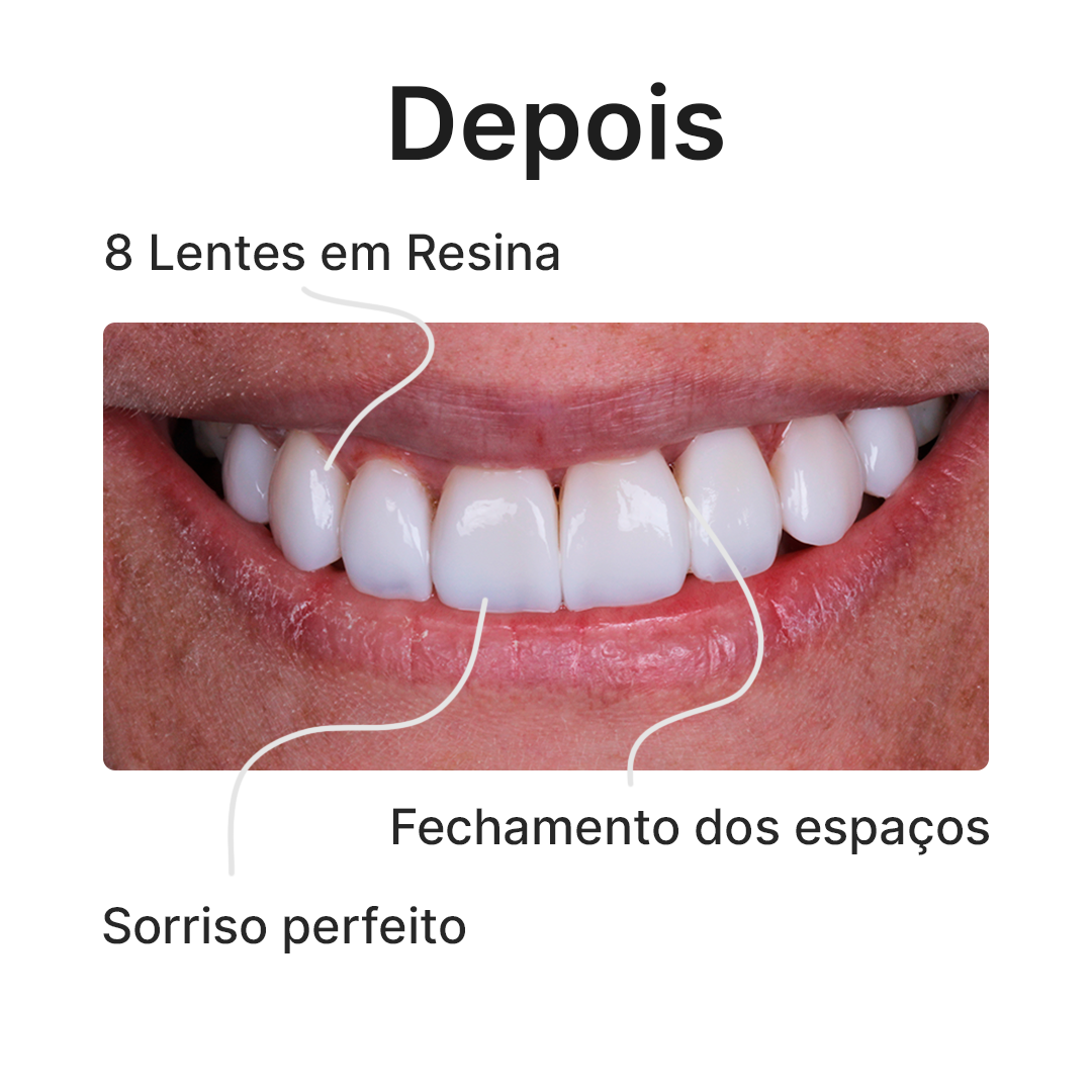 Depois-V5